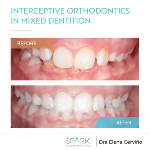 Spark: Interceptive orthodontics in mixed dentition