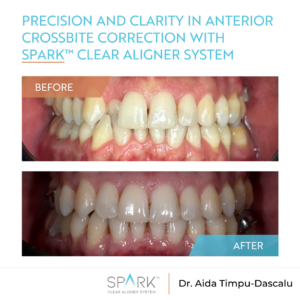 Precision and clarity in anterior crossbite correction with Spark™ Clear Aligner system
